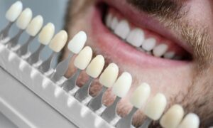 Carillas dentales: ¿qué son y para qué sirven?